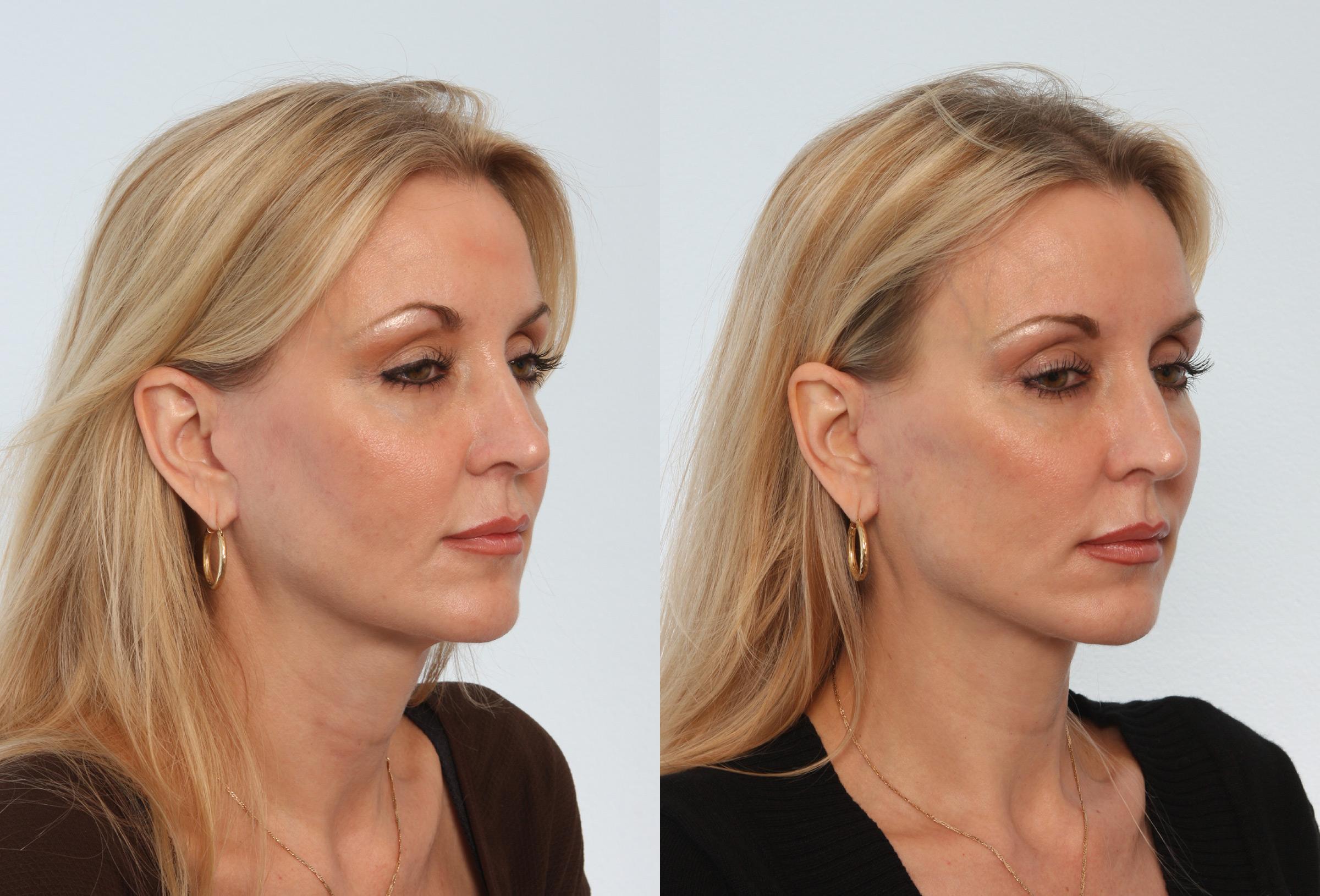 Neck Lift Procedure - Everything you need to know about - Bombay