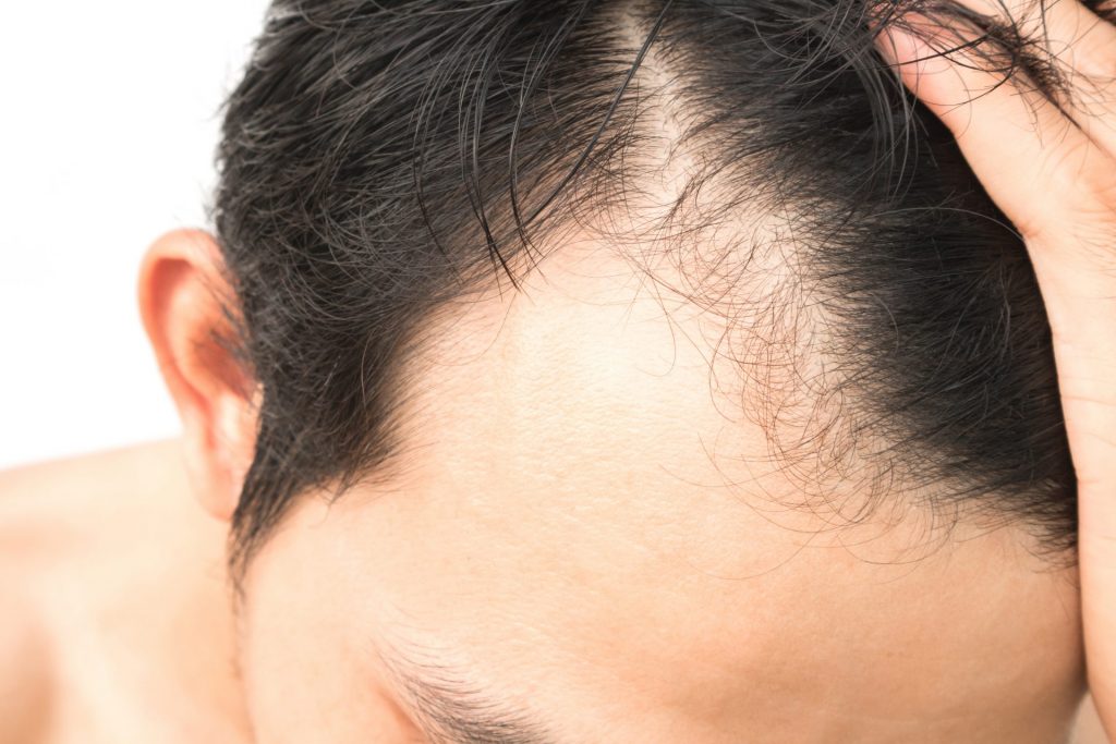 What Is The Right Age To Undergo Hair Transplantation Surgery  Cyber  Hairsure
