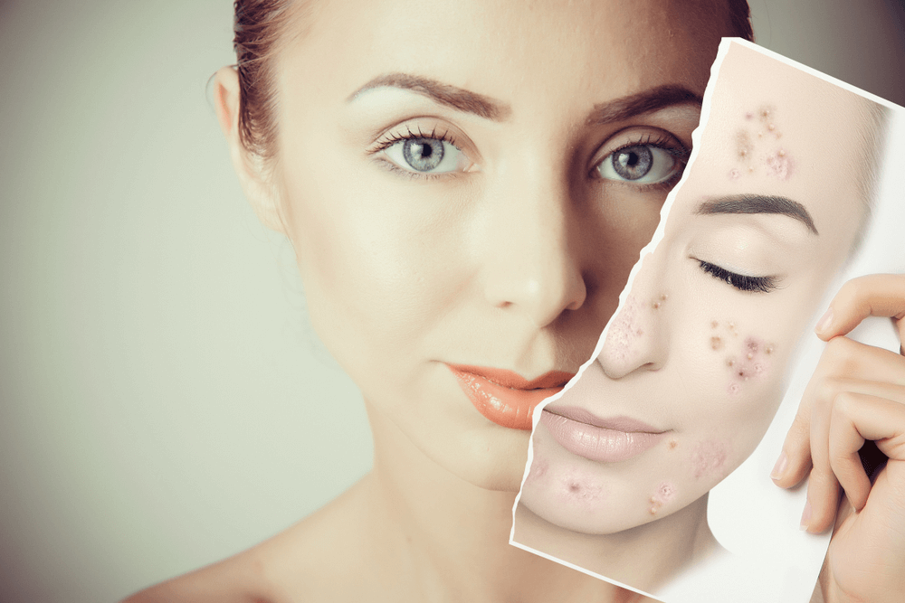 laser acne pimple treatment in navi mumbai