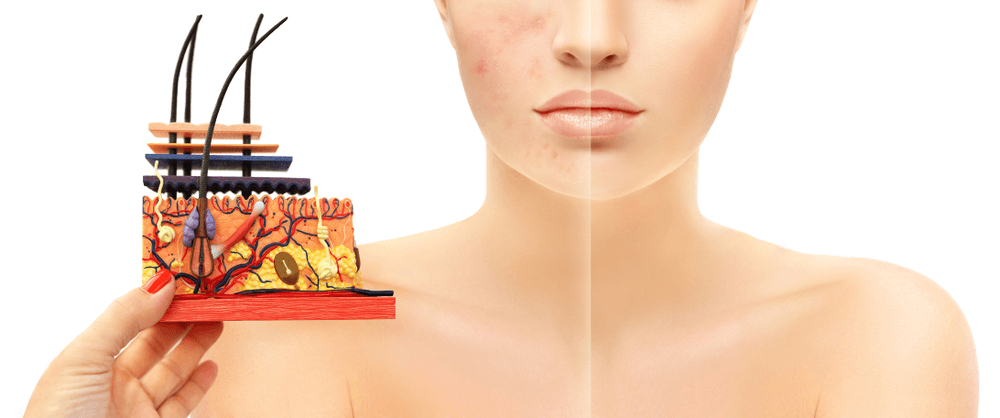 laser acne scar treatment in navi mumbai