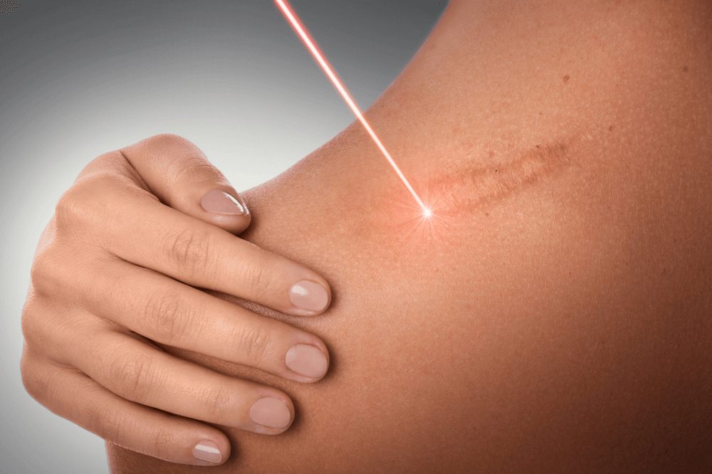 laser scar removal treatment in navi mumbai