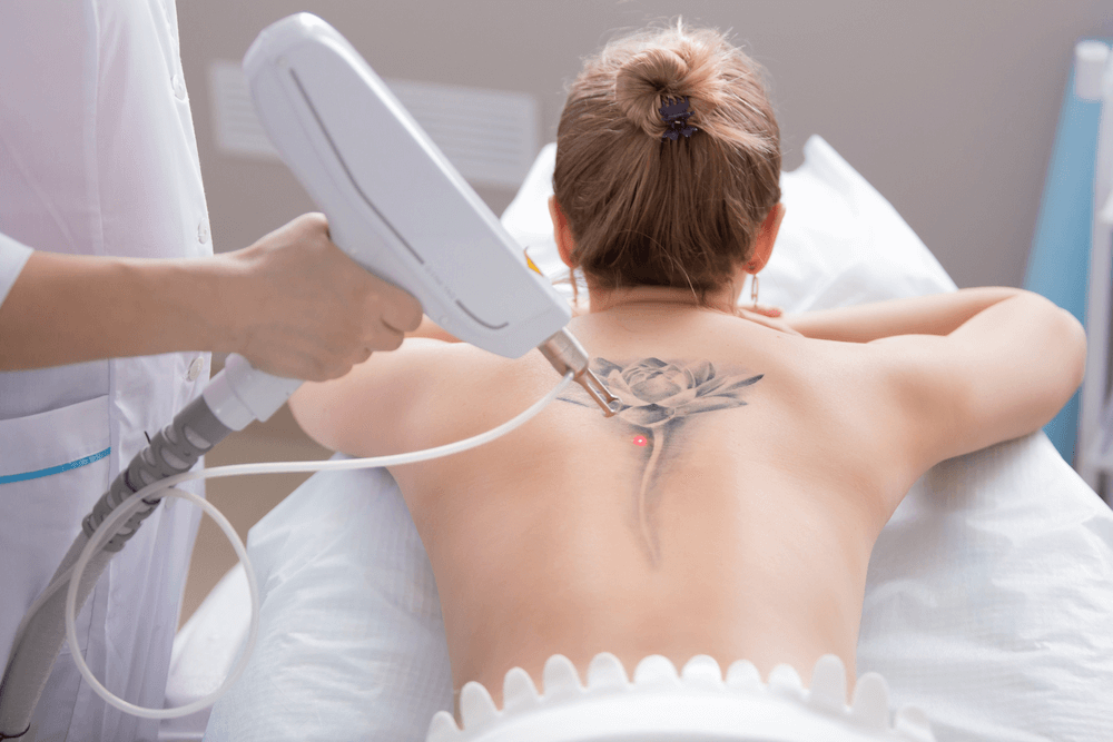 laser tattoo removal treatment in navi mumbai