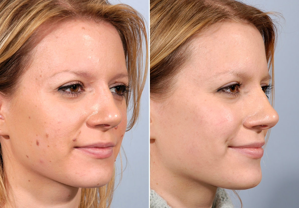 Facial Mole Removal Scarring