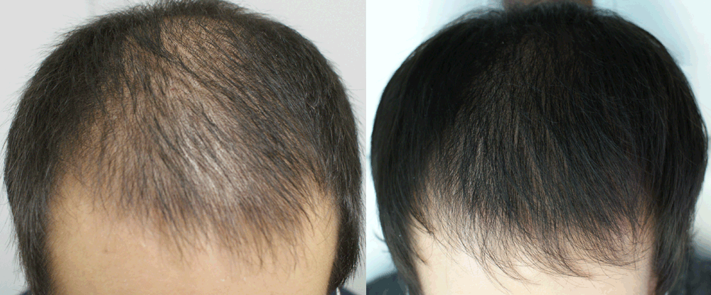 platelet rich plasma therapy (prp) in hair restoration in navi mumbai