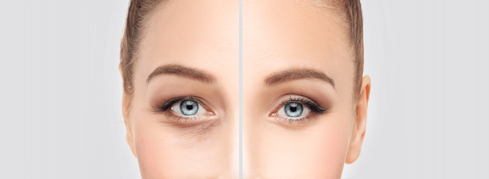 eyelid surgery blepharoplasty in navi mumbai