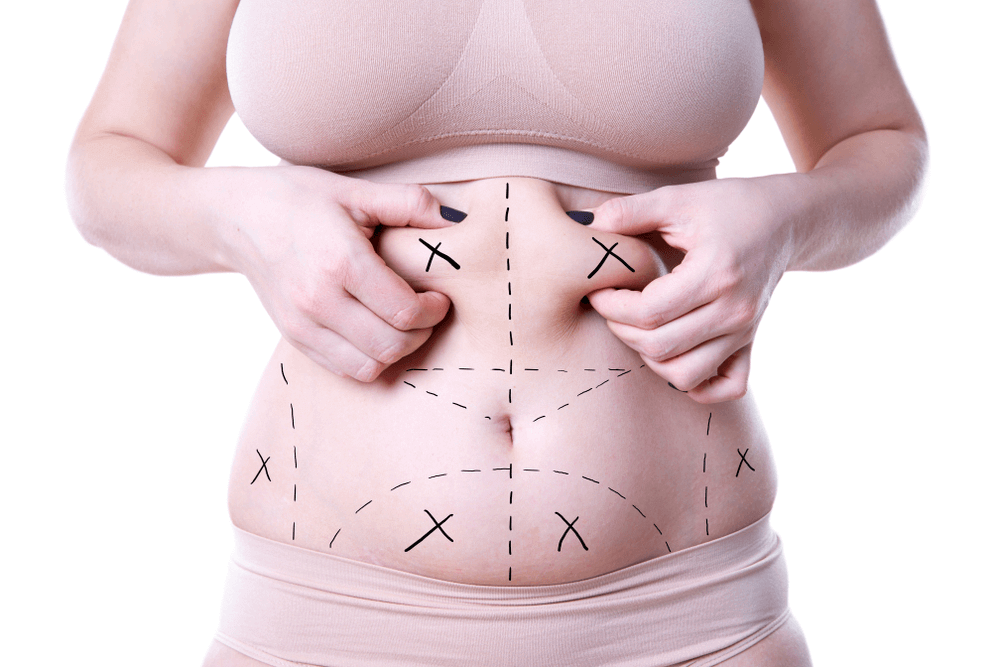 liposuction - fat removal procedure used in plastic surgery in navi mumbai