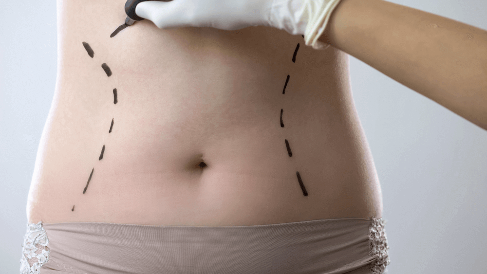 abdominoplasty - tummy tuck surgery in navi mumbai